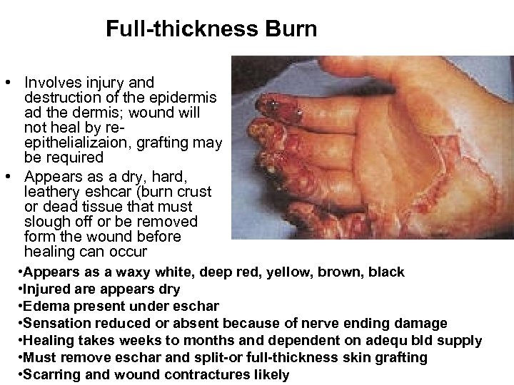 Full-thickness Burn • Involves injury and destruction of the epidermis ad the dermis; wound