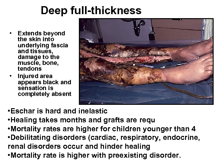 Deep full-thickness • Extends beyond the skin into underlying fascia and tissues, damage to
