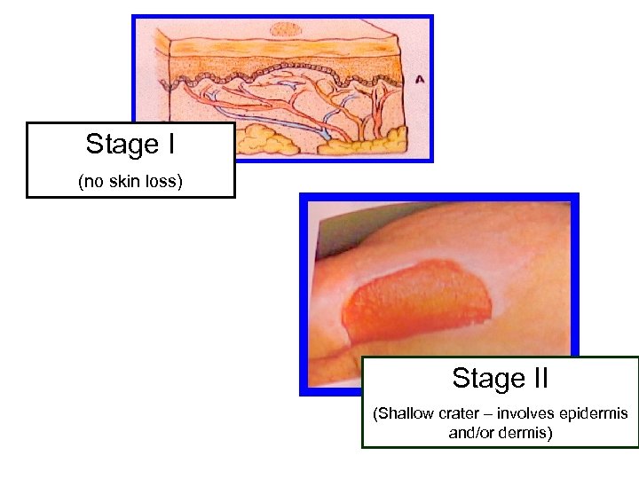 Stage I (no skin loss) Stage II (Shallow crater – involves epidermis and/or dermis)