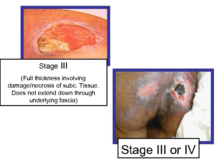 Stage III (Full thickness involving damage/necrosis of subc. Tissue. Does not extend down through