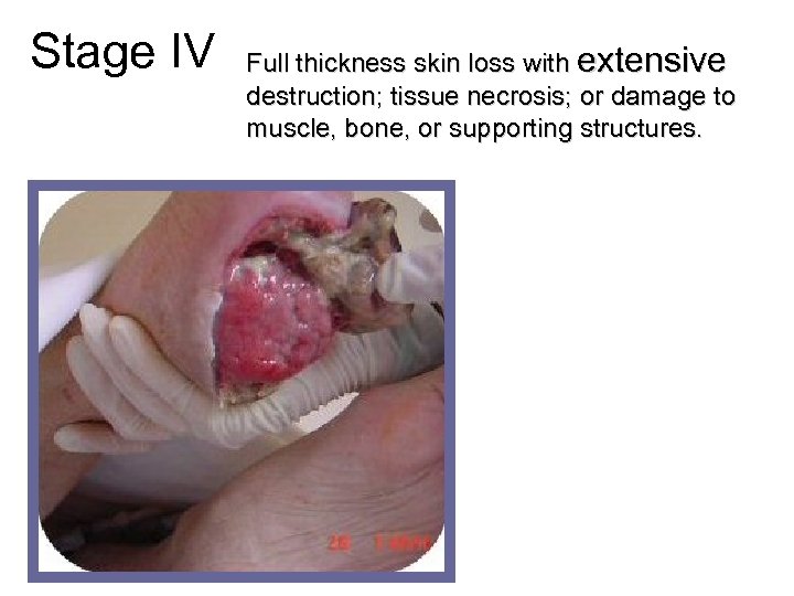 Stage IV Full thickness skin loss with extensive destruction; tissue necrosis; or damage to