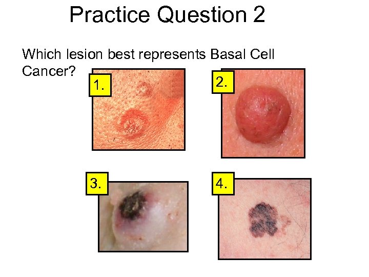 Practice Question 2 Which lesion best represents Basal Cell Cancer? 2. 1. 3. 4.