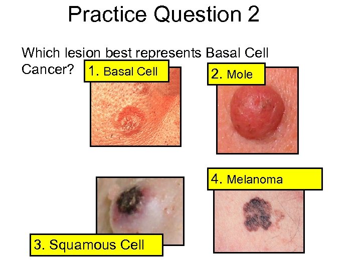 Practice Question 2 Which lesion best represents Basal Cell Cancer? 1. Basal Cell 2.