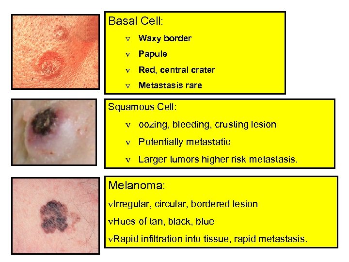 Basal Cell: v Waxy border v Papule v Red, central crater v Metastasis rare