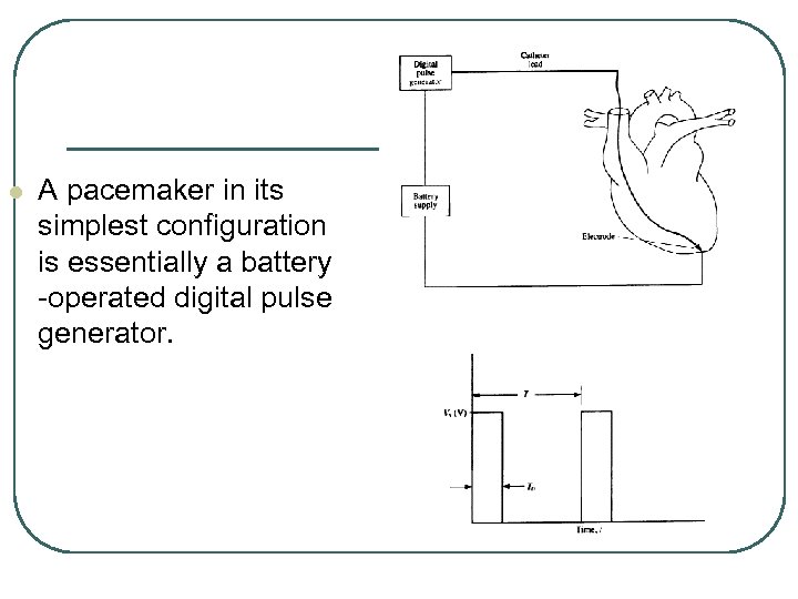 l A pacemaker in its simplest configuration is essentially a battery -operated digital pulse