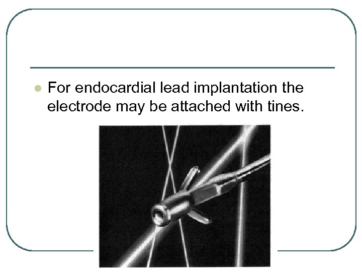 l For endocardial lead implantation the electrode may be attached with tines. 