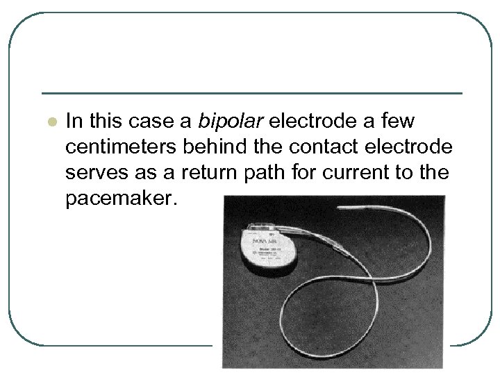 l In this case a bipolar electrode a few centimeters behind the contact electrode