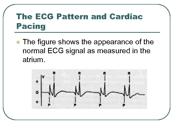 The ECG Pattern and Cardiac Pacing l The figure shows the appearance of the