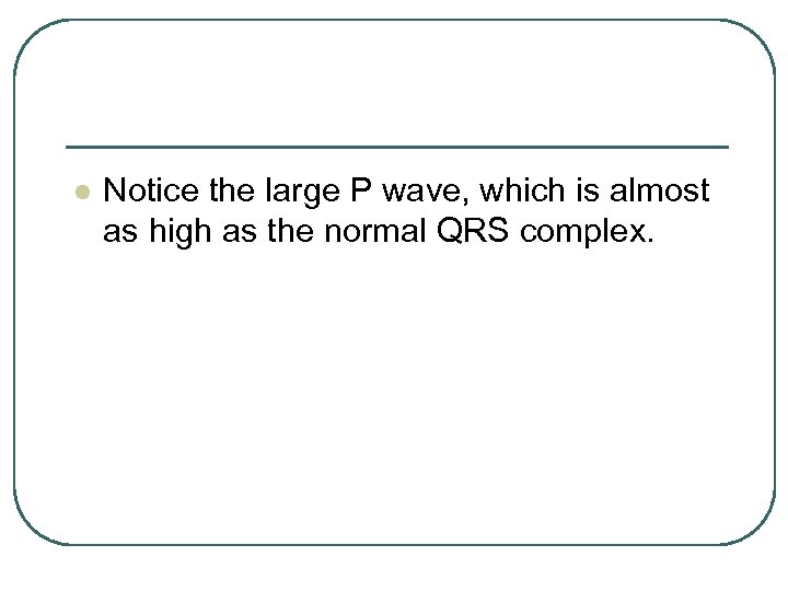 l Notice the large P wave, which is almost as high as the normal