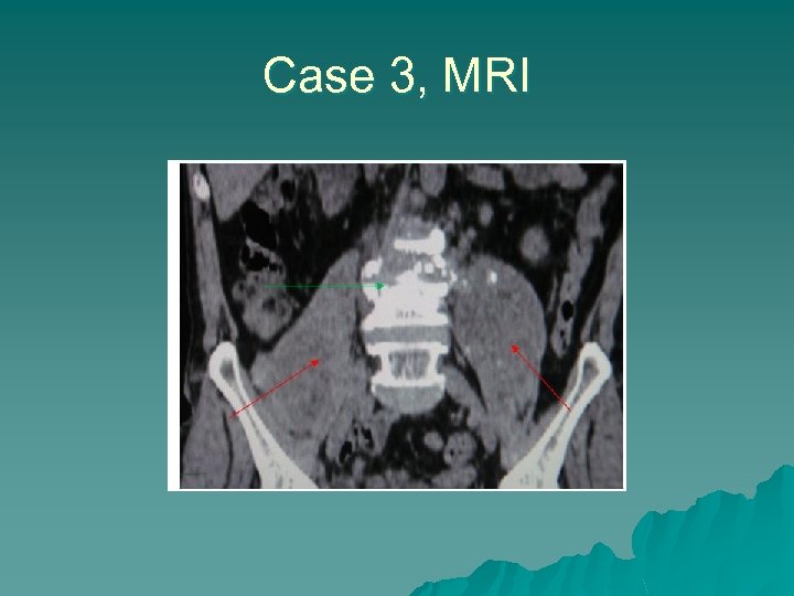 Case 3, MRI 