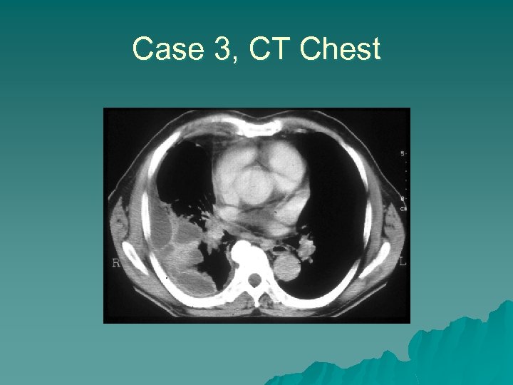 Case 3, CT Chest 