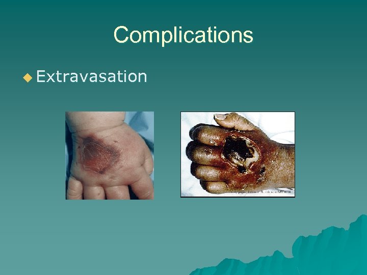 Complications u Extravasation 