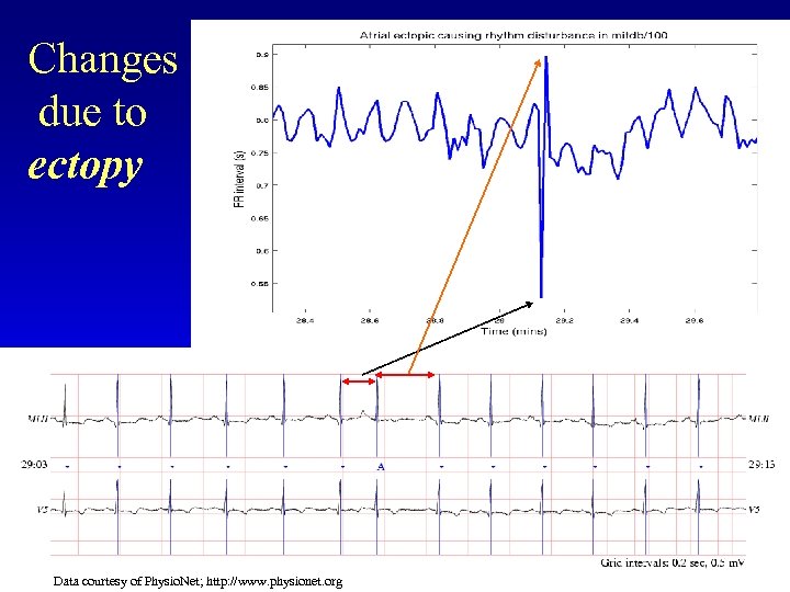 Changes due to ectopy Data courtesy of Physio. Net; http: //www. physionet. org 