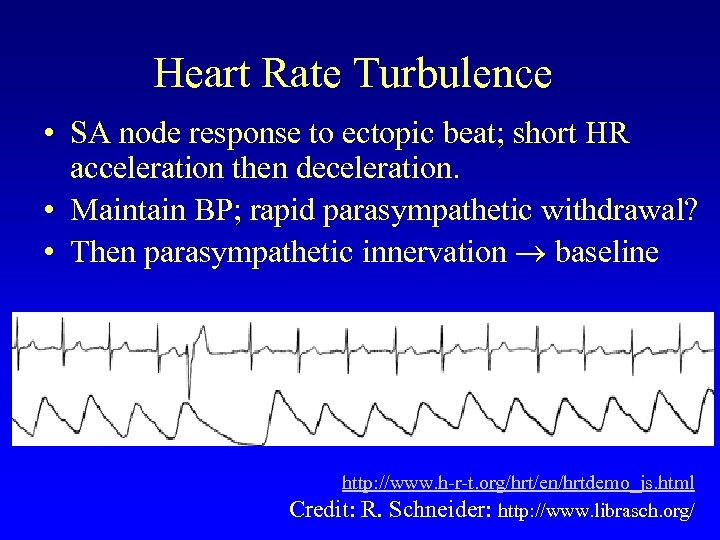 Heart Rate Turbulence • SA node response to ectopic beat; short HR acceleration then