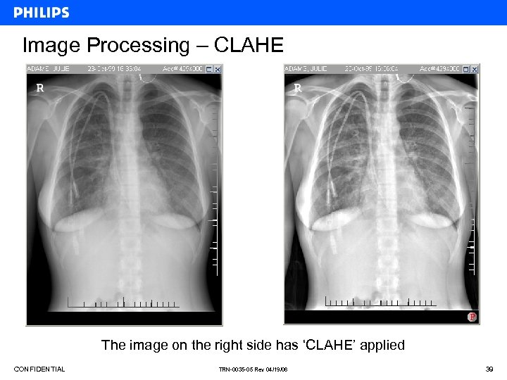 Image Processing – CLAHE The image on the right side has ‘CLAHE’ applied CONFIDENTIAL