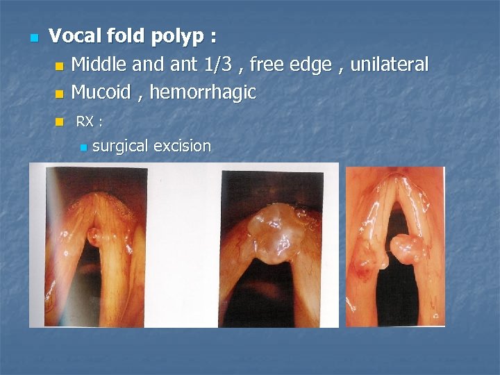 n Vocal fold polyp : n Middle and ant 1/3 , free edge ,