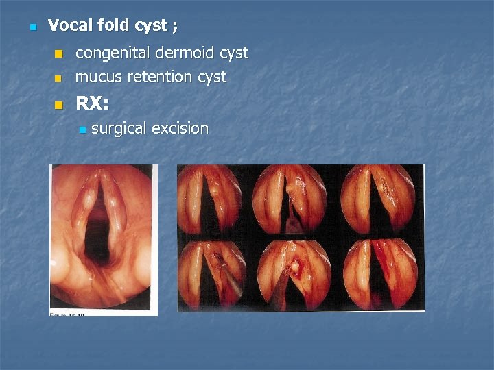 n Vocal fold cyst ; n congenital dermoid cyst mucus retention cyst n RX: