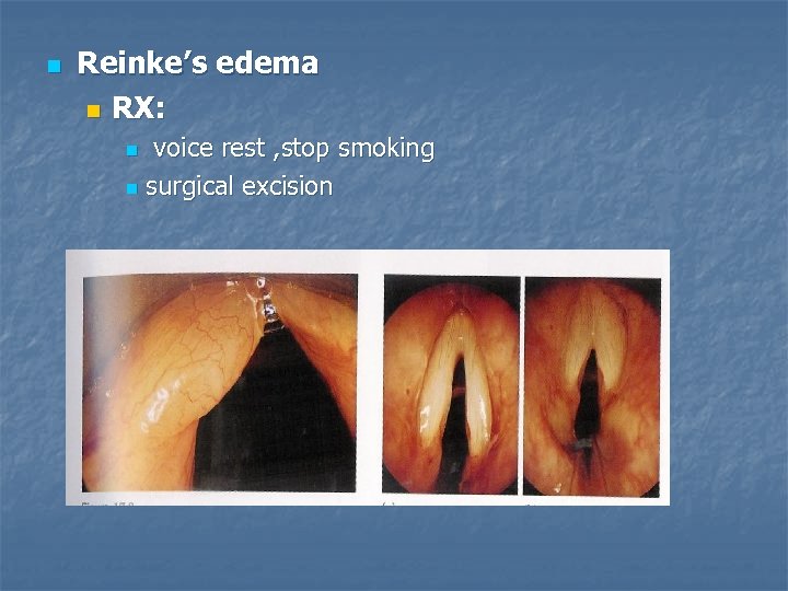 n Reinke’s edema n RX: voice rest , stop smoking n surgical excision n