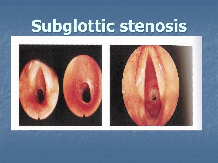 Subglottic stenosis 