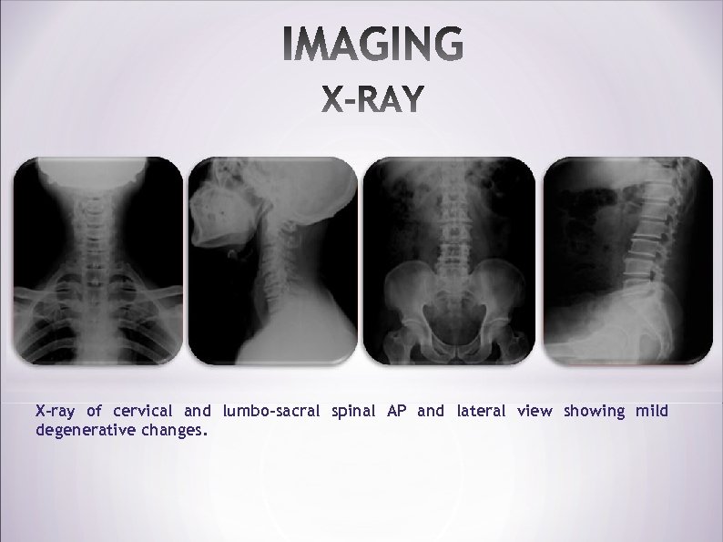 X-ray of cervical and lumbo-sacral spinal AP and lateral view showing mild degenerative changes.