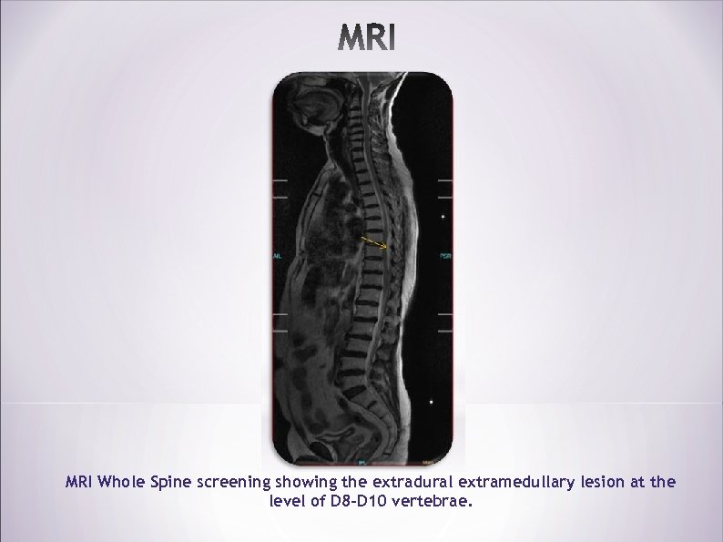 MRI Whole Spine screening showing the extradural extramedullary lesion at the level of D