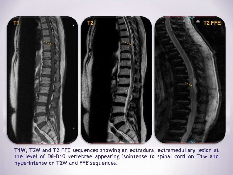 T 1 W, T 2 W and T 2 FFE sequences showing an extradural