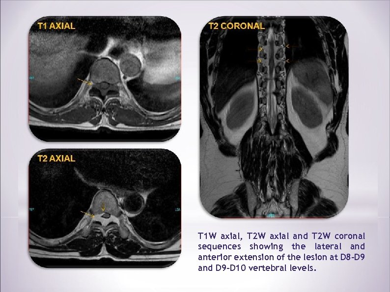 T 1 W axial, T 2 W axial and T 2 W coronal sequences