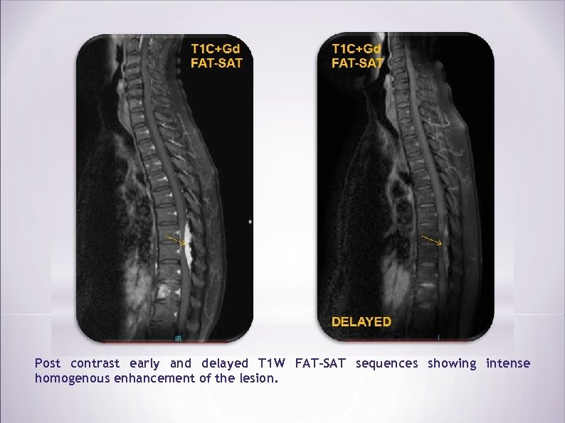 Post contrast early and delayed T 1 W FAT-SAT sequences showing intense homogenous enhancement