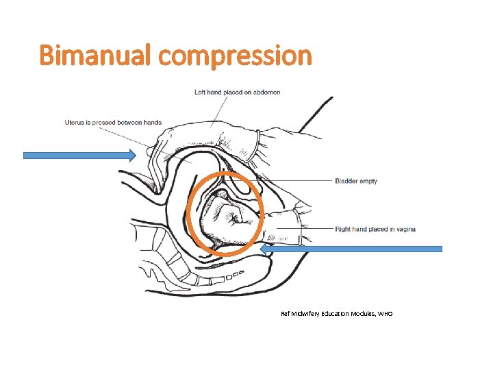 Bimanual compression Ref Midwifery Education Modules, WHO 