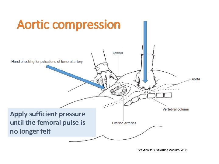 Aortic compression Apply sufficient pressure until the femoral pulse is no longer felt Ref