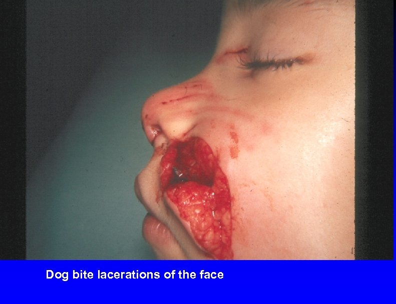 Dog bite lacerations of the face 