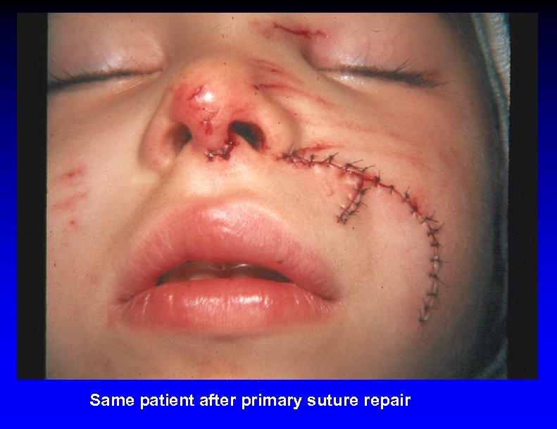 Same patient after primary suture repair 