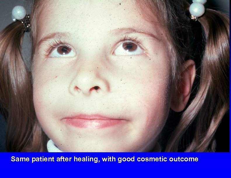 Same patient after healing, with good cosmetic outcome 