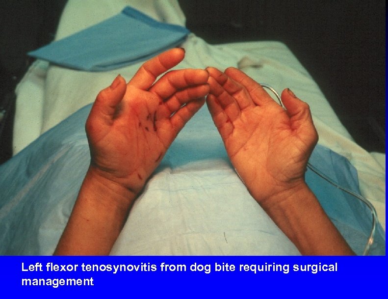 Left flexor tenosynovitis from dog bite requiring surgical management 