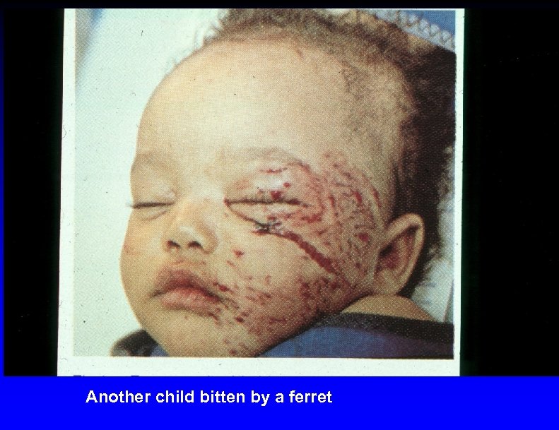 Another child bitten by a ferret 