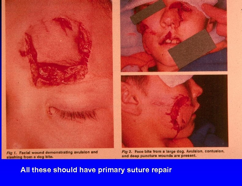 All these should have primary suture repair 