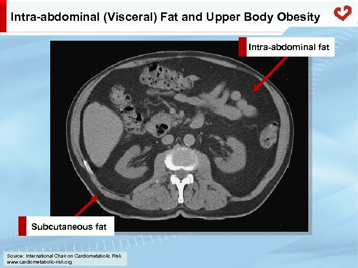 Intra-abdominal (Visceral) Fat and Upper Body Obesity Intra-abdominal fat Subcutaneous fat Source: International Chair