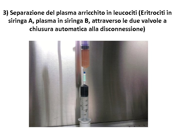 3) Separazione del plasma arricchito in leucociti (Eritrociti in siringa A, plasma in siringa