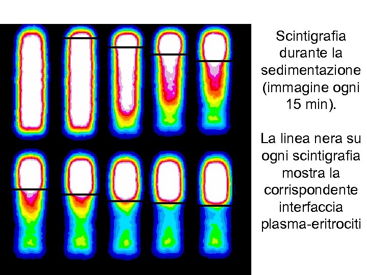 Scintigrafia durante la sedimentazione (immagine ogni 15 min). La linea nera su ogni scintigrafia