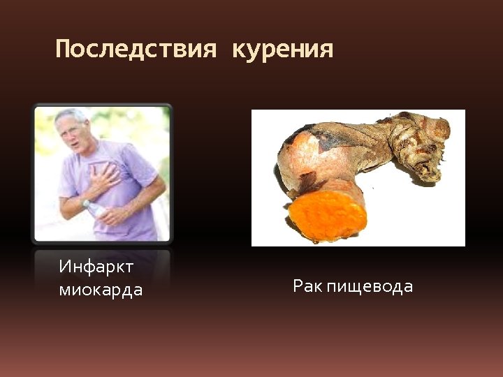 Последствия курения Инфаркт миокарда Рак пищевода 