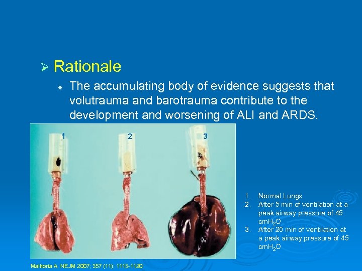 Ø Rationale l 1 The accumulating body of evidence suggests that volutrauma and barotrauma