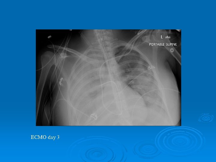 ECMO day 3 