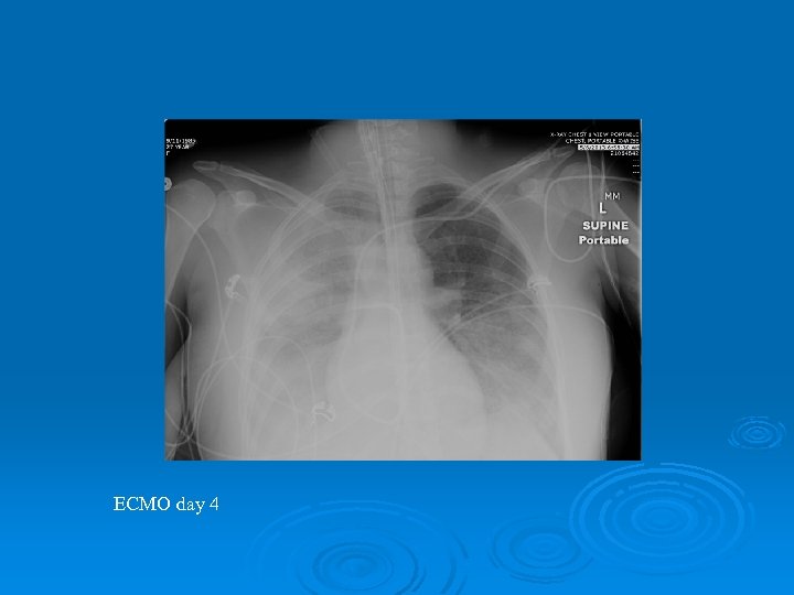 ECMO day 4 