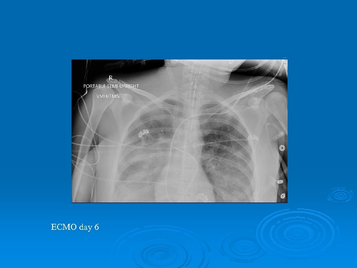 ECMO day 6 