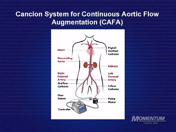 Cancion System for Continuous Aortic Flow Augmentation (CAFA) 