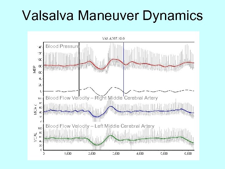 Valsalva Maneuver Dynamics Blood Pressure Blood Flow Velocity – Right Middle Cerebral Artery Blood