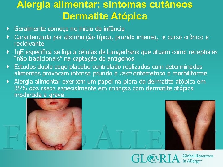 Alergia alimentar: sintomas cutâneos Dermatite Atópica · Geralmente começa no início da infância ·