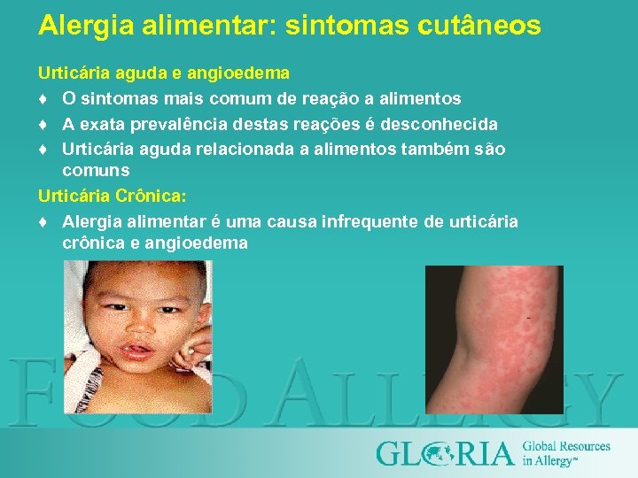 Alergia alimentar: sintomas cutâneos Urticária aguda e angioedema ♦ O sintomas mais comum de