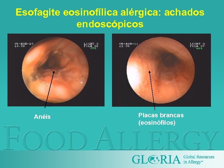 Esofagite eosinofílica alérgica: achados endoscópicos Anéis Placas brancas (eosinófilos) 