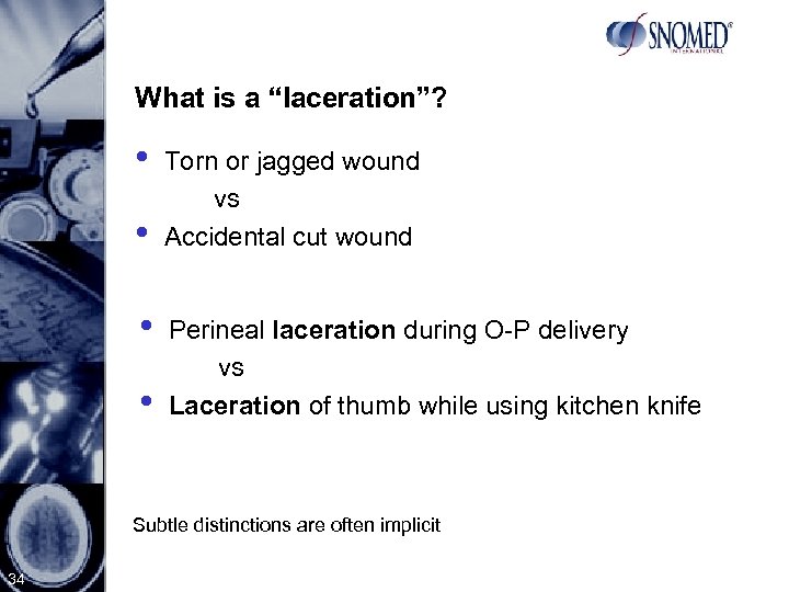 What is a “laceration”? • • Torn or jagged wound vs Accidental cut wound